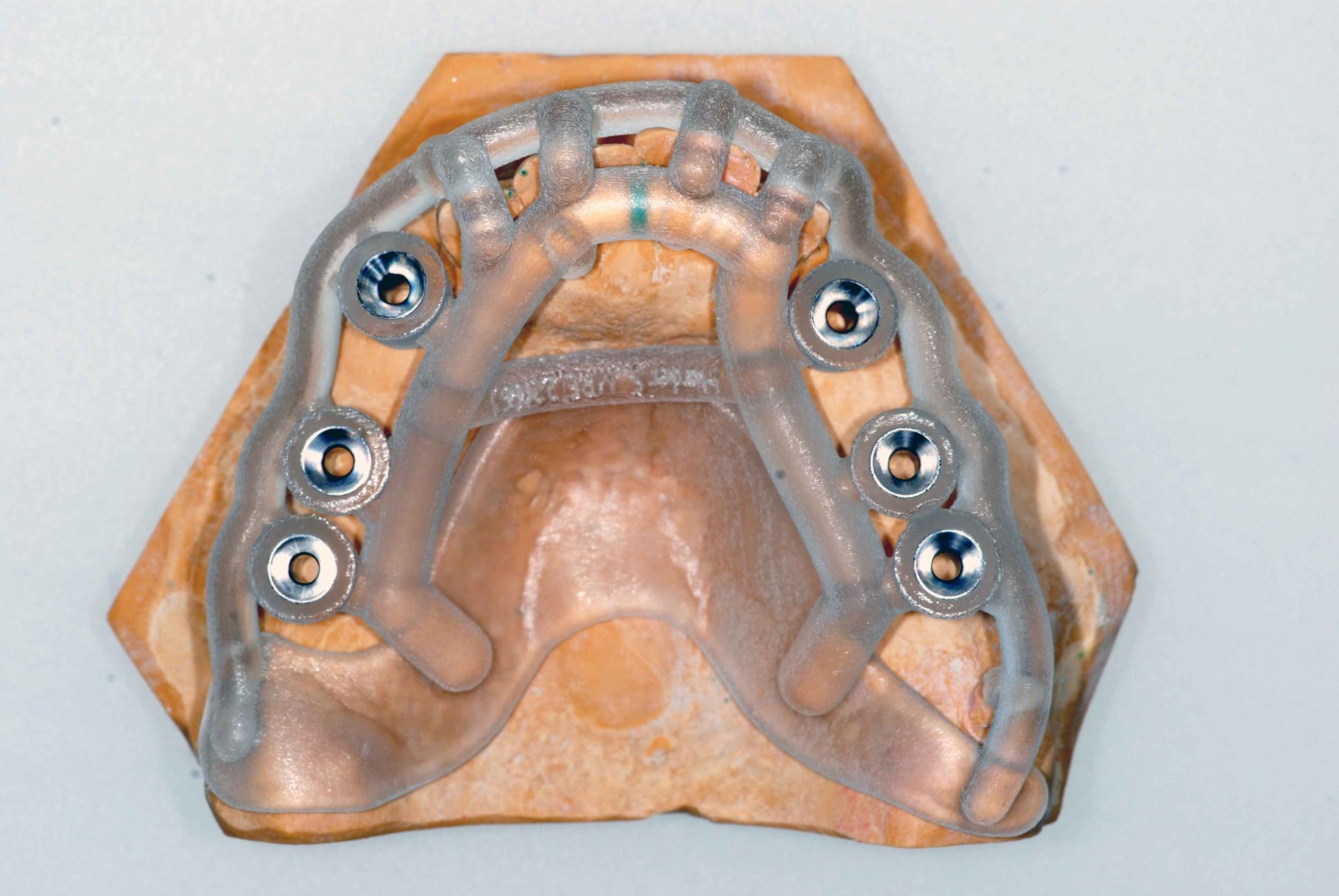 Ghid chirurgical printat 3D, așezat pe un model dentar, pentru inserarea ghidată a unui implant
