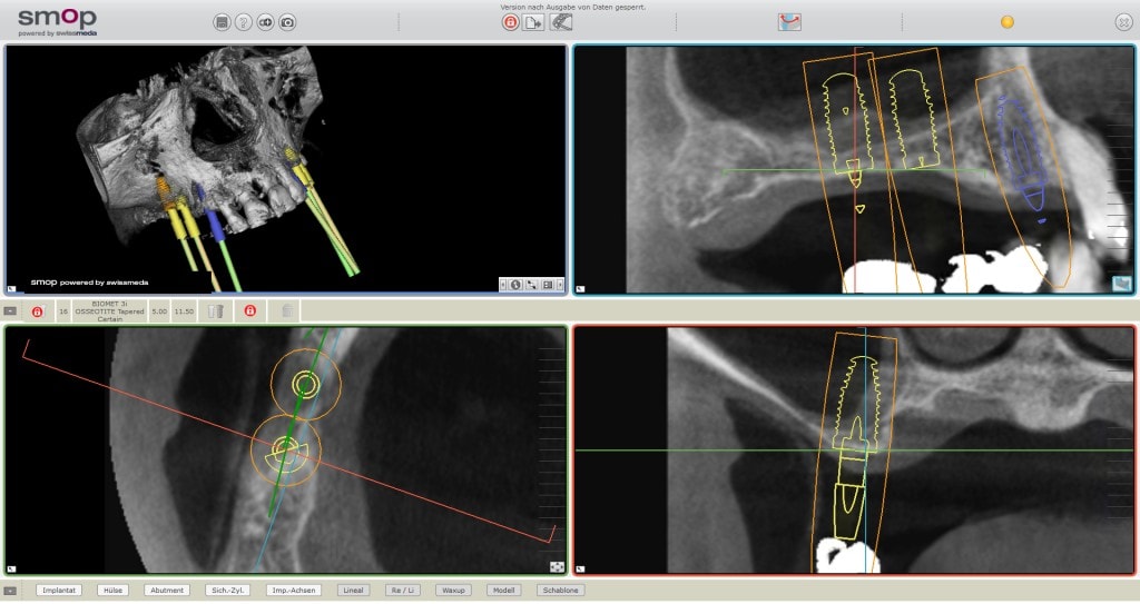Planificare virtuală a unui implant dentar pe imagini CBCT, cu reconstrucție 3D și secțiuni prin os