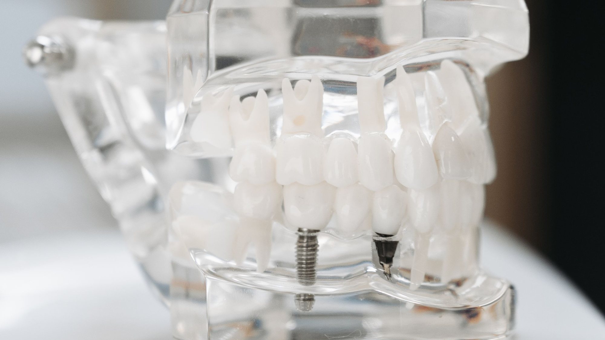Model dentar transparent cu implanturi inserate în os, sub dinți