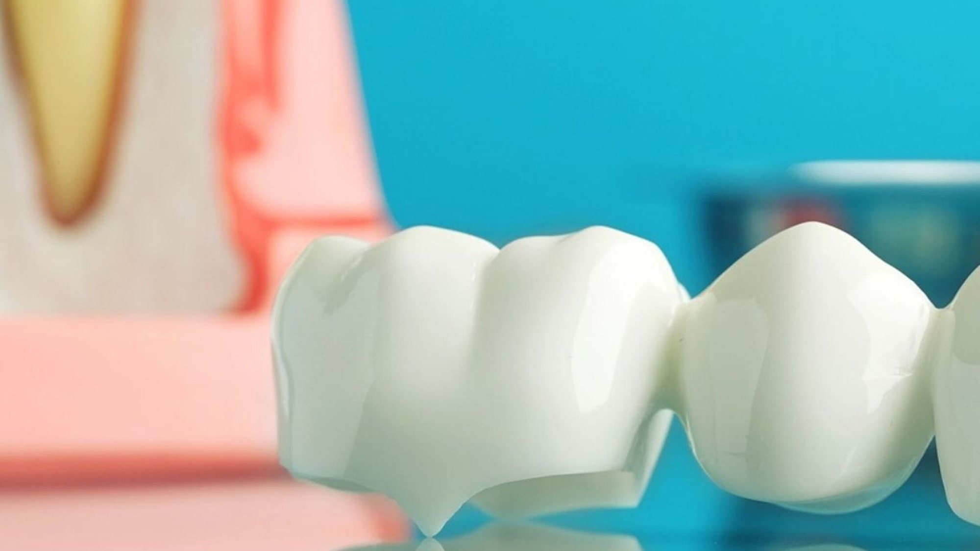 Lucrare dentară din coroane unite, așezată lângă un model de dinte în secțiune